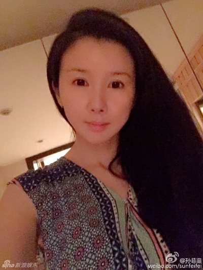 孙菲菲整容失败复盘，面部僵硬与馒化如何修复？